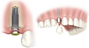 implantes-dentales 2