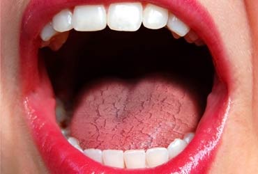 Síndrome de la boca seca
